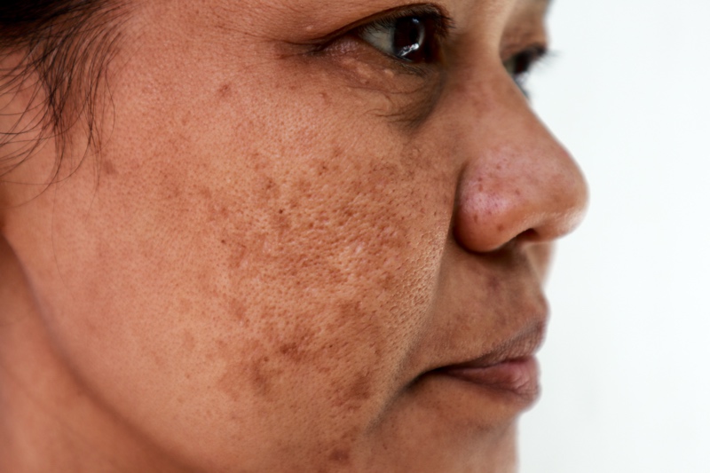 Picture of a woman with a more melanated skin condition called Melasma