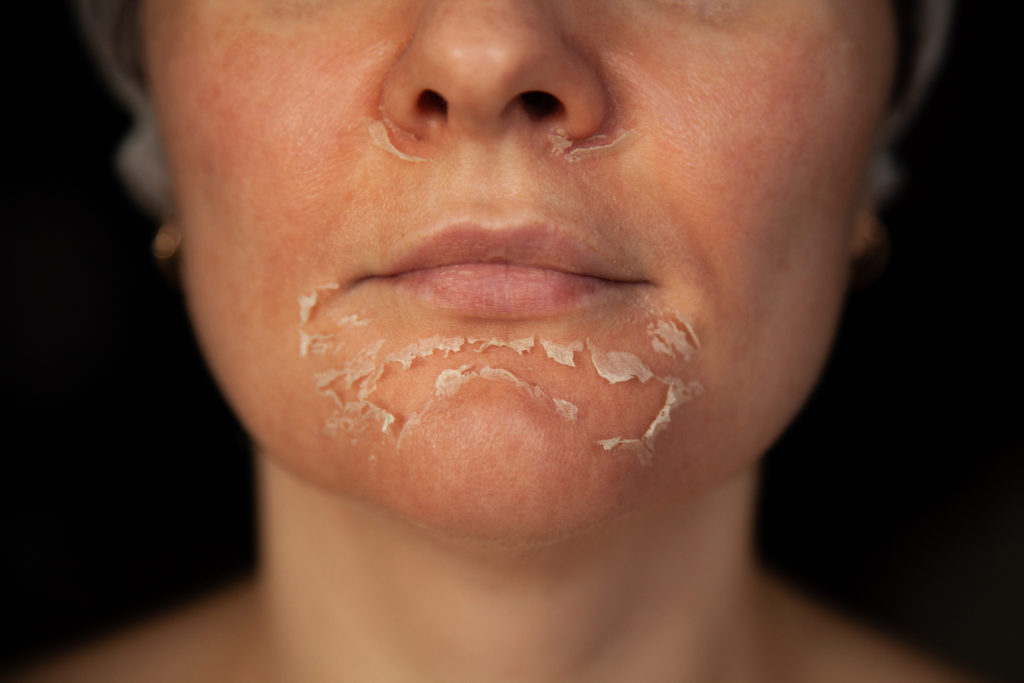 A girl with over flaky or over peeled skin due to exceeding the amount of retinol usage