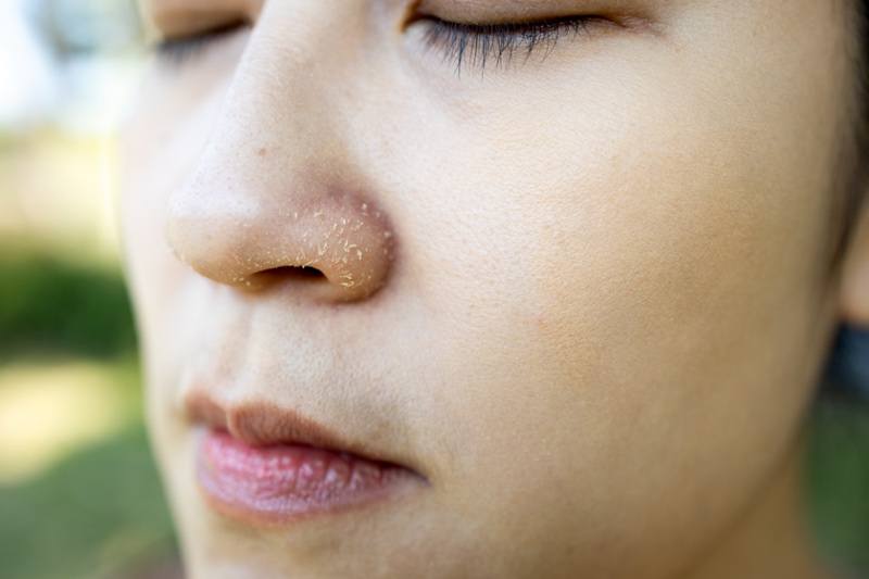 Young woman showing dry skin on nose