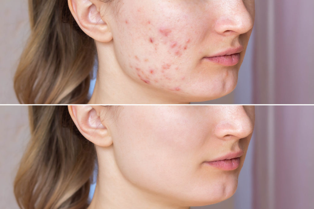 A before-after picture of a girl with acne condition after following all the mentioned rules