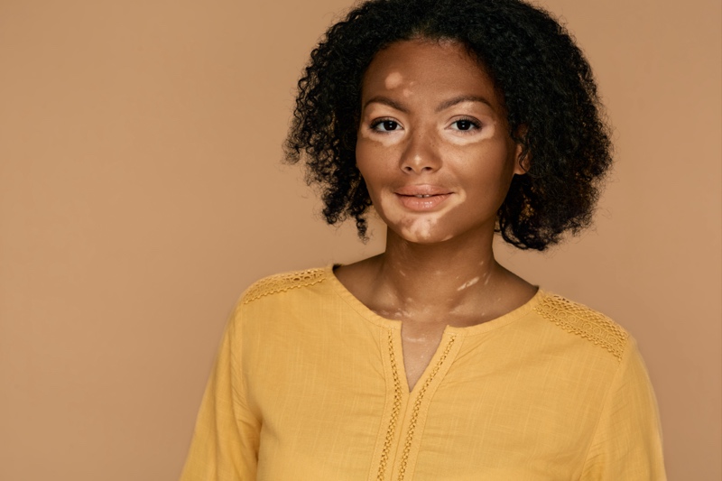 A picture of a woman with a skin condition called Vitiligo.