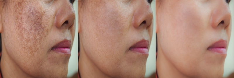 Picture of a girl with hyperpigmentation cure stages with regular usage of Retinol