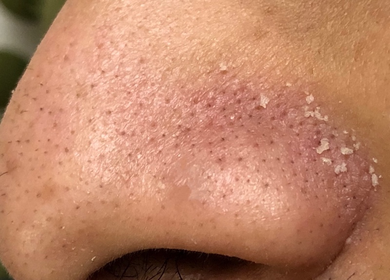 Picture of a severe case of Seborrheic Dermatitis (a type of dry skin condition)