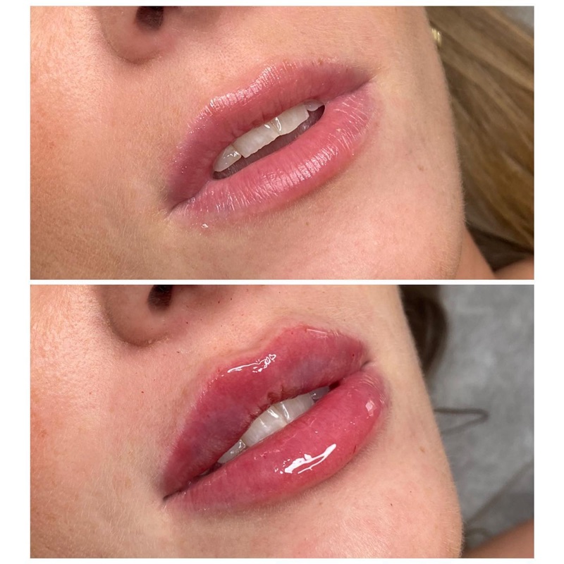 Before and after picture of a girl with lip procedure treatment 