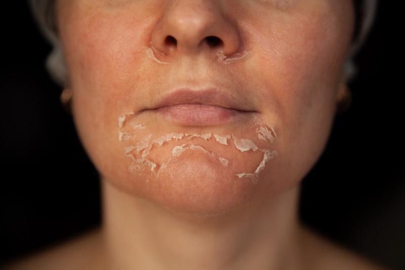 Over peeled skin of a girl due to exceeding the amount of retinol