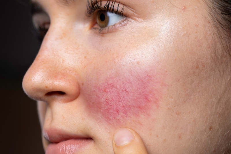 Girl with a chemical reaction from the careless usage of acids like retinol and glycolic acid