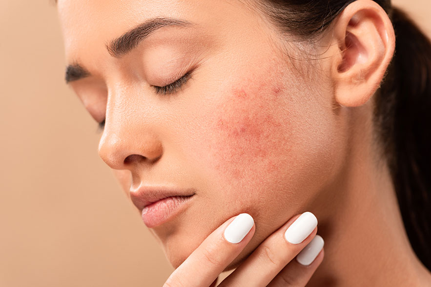 A girl with acne condition on the skin