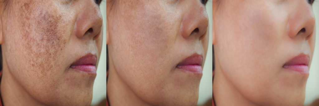 A girl showing Hyperpigmentation stages with consistent use of Retinol