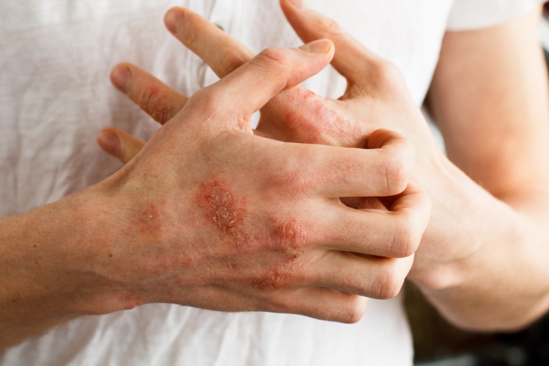 Picture of a man with Eczema on his hand