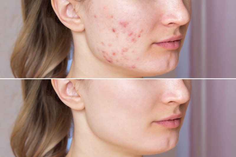 Tretinoin before-after usage effects