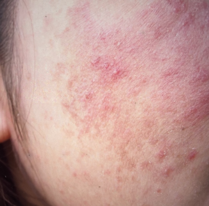 Tretinoin purging phase of a girl in the picture
